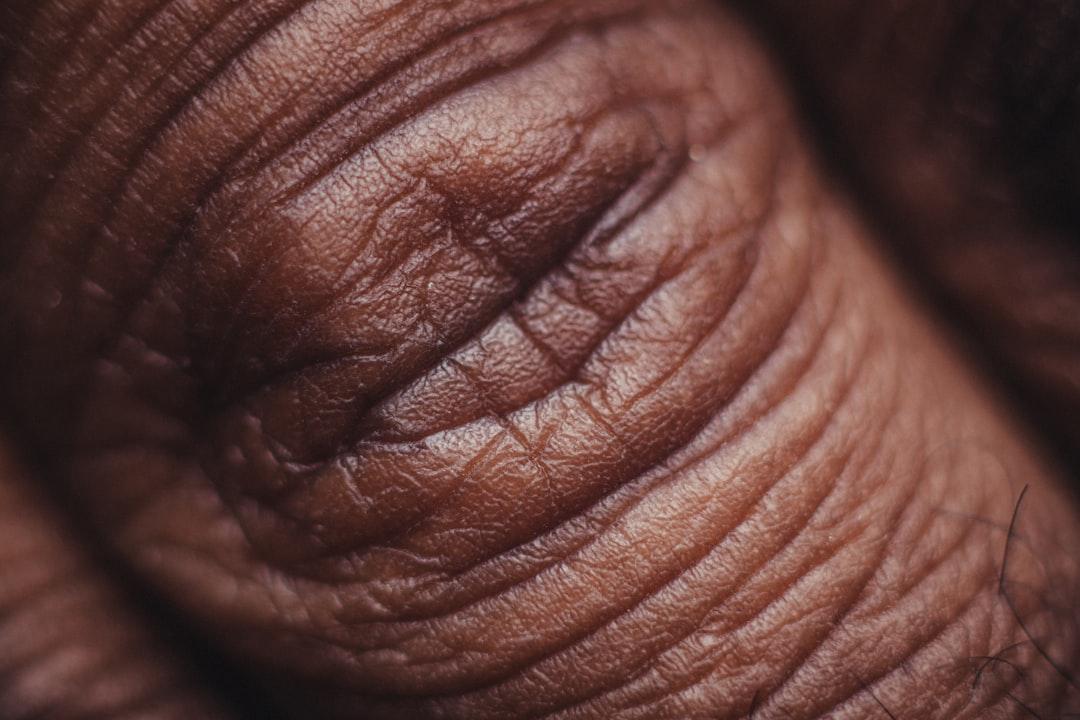 Persons hand in close up image from Nsey Benajah on Unsplash BỆNH CHỐC